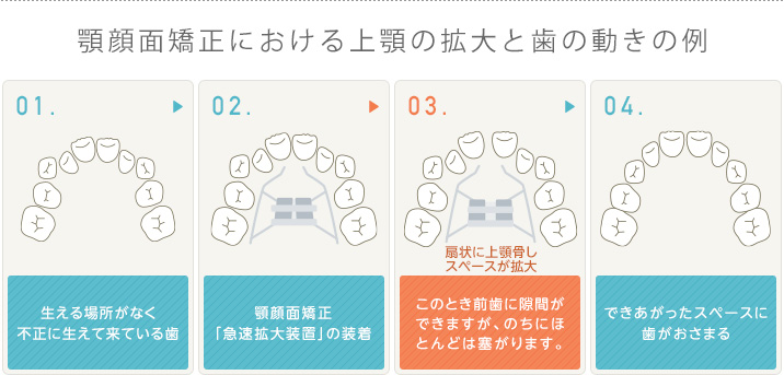 顎顔面矯正における上顎の拡大と歯の動きの例