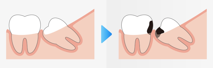 親知らずからの虫歯