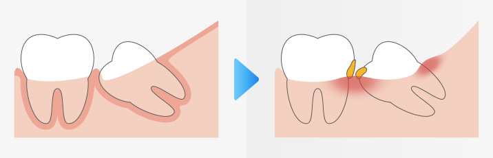 親知らずからの歯周病